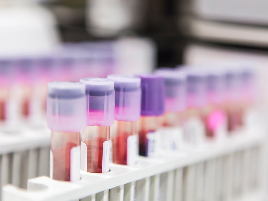 Vials of blood in a rack